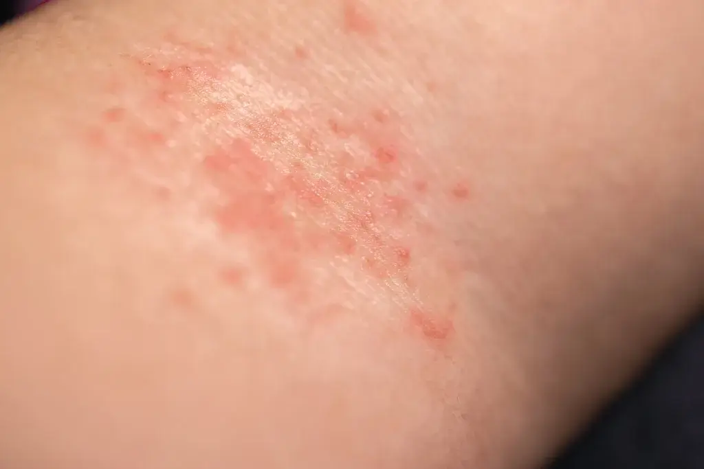 Poison Oak blisters on skin